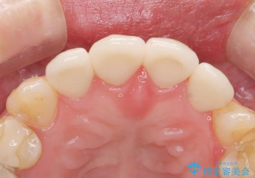 前歯綺麗にしたい。の治療後