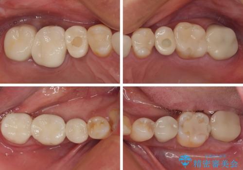 新幹線通院 地元で断られた奥歯のむし歯治療の治療後