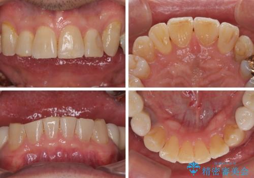 奥歯の欠損と前歯のデコボコを治したい インプラントと矯正治療の総合歯科治療の治療後