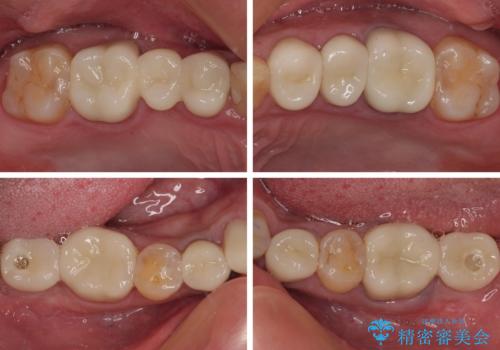 銀歯を白くしたい 一緒に矯正治療も行ない美しい口腔内にの治療後