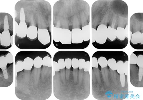 強い咬合力で奥歯がボロボロに インプラント治療による咬合回復と全顎セラミック治療の治療後