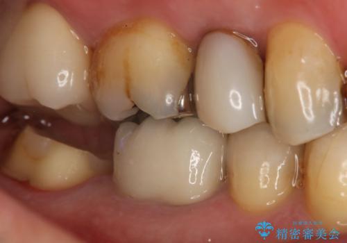 奥歯が痛む オールセラミッククラウンの治療中