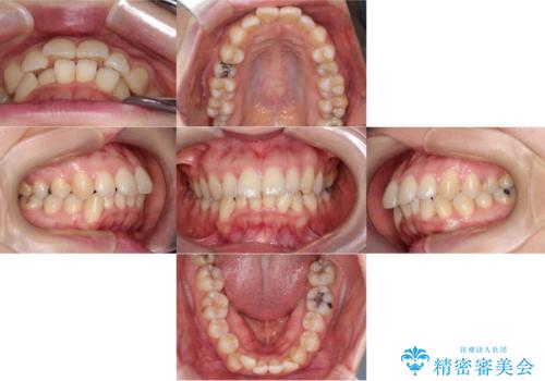 口ボコと歯のデコボコが気になる!|前歯が出ていて口が閉じにくい|審美ワイヤー矯正による口元の改善!の治療前