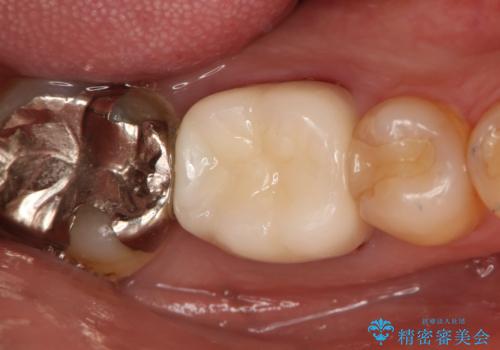 奥歯が痛む オールセラミッククラウンの治療前