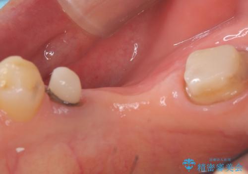 【ゴールドクラウン】セラミックのブリッジが何度も壊れるの治療中