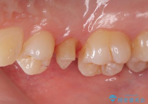 【根管治療】【セラミッククラウン】根っこが細くて治療できないと言われたの治療中