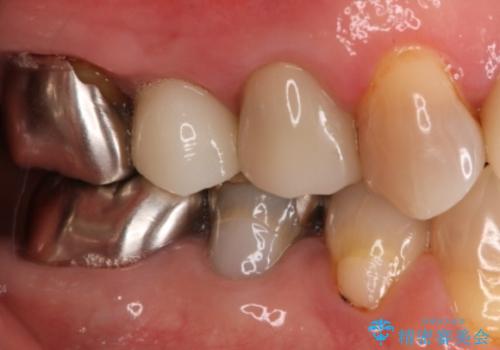 上の奥歯が折れた 抜歯即時埋入インプラントの治療後