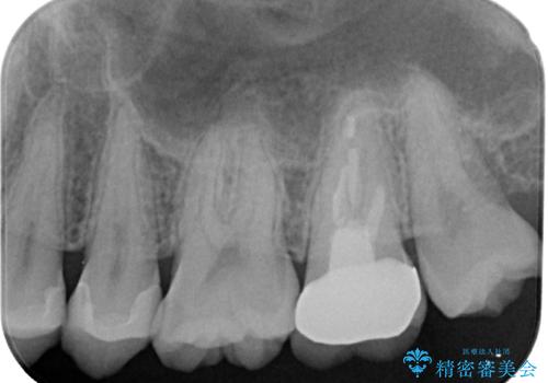 レジンが劣化してきた オールセラミッククラウンの治療後