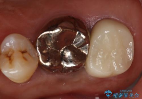 奥歯が取れた フルジルコニアクラウンの症例 治療後
