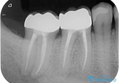 奥歯が痛む オールセラミッククラウンの治療後