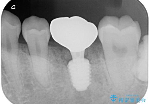 咬合力で破折した奥歯 抜歯即時埋入インプラントによる補綴治療の治療後