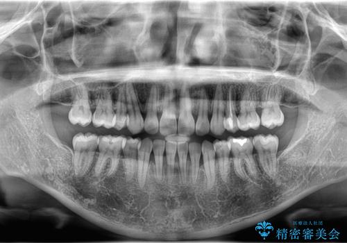 口ボコと歯のデコボコが気になる!|前歯が出ていて口が閉じにくい|審美ワイヤー矯正による口元の改善!の治療後