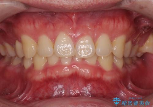 下の歯のがたつきが気になる。 インビザラン&ワイヤー部分矯正併用の治療前