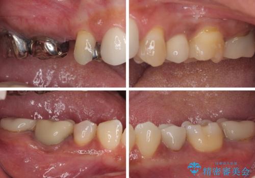 新幹線通院 地元で断られた奥歯のむし歯治療の治療前