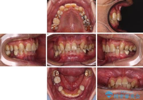 奥歯の欠損と前歯のデコボコを治したい インプラントと矯正治療の総合歯科治療の治療前