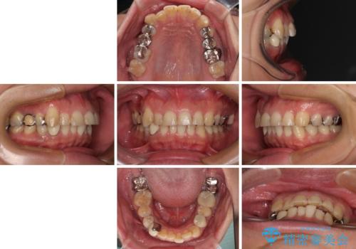 銀歯を白くしたい 一緒に矯正治療も行ない美しい口腔内にの治療前
