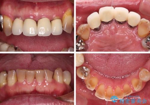 強い咬合力で奥歯がボロボロに インプラント治療による咬合回復と全顎セラミック治療の治療前