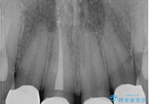 前歯綺麗にしたい。の治療後