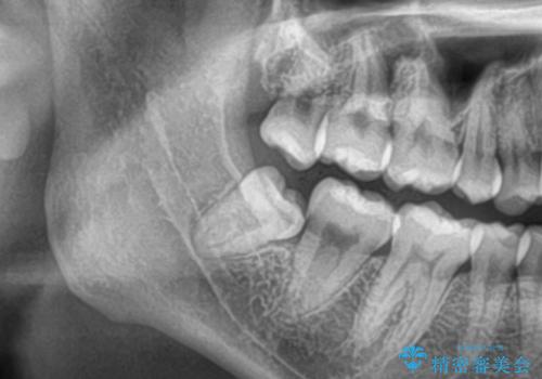 親知らず抜きたい。の治療前