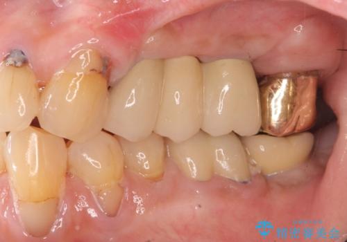 入れ歯では食事を楽しめない。インプラントによる咬合機能回復の治療後