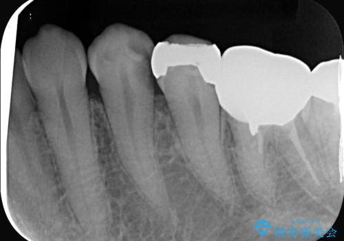 神経を抜かずに深い虫歯を治療の治療前