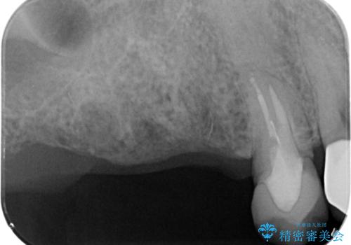 欠損した奥歯 インプラント補綴の治療前