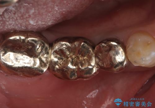 【ゴールドクラウン】セラミックのブリッジが何度も壊れるの症例 治療後