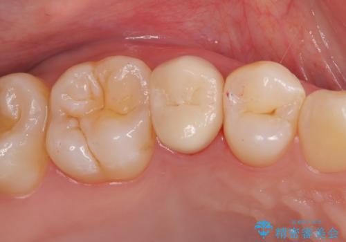 【根管治療】【セラミッククラウン】根っこが細くて治療できないと言われたの症例 治療後