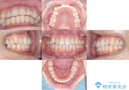 非抜歯矯正で八重歯を改善|短期間8か月で美しい歯並びに|インビザラインライト上顎のみで矯正の治療中