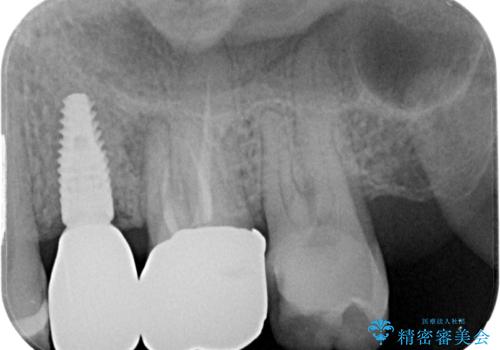 銀歯がとれたのでやり替えたい オールセラミッククラウンの治療前