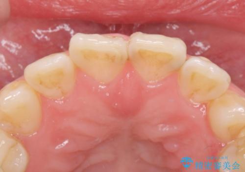 前歯綺麗にしたい。の治療前