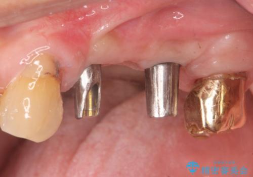 入れ歯では食事を楽しめない。インプラントによる咬合機能回復の治療中