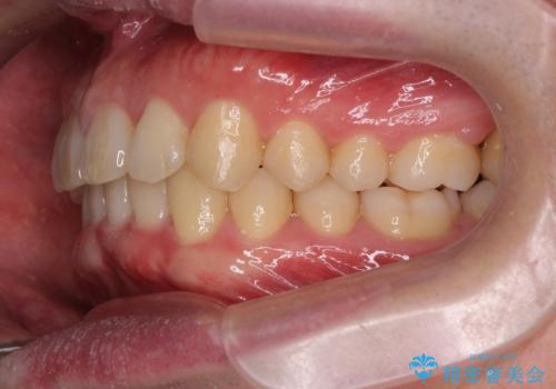 下の歯のがたつきが気になる。 インビザラン&ワイヤー部分矯正併用の治療後