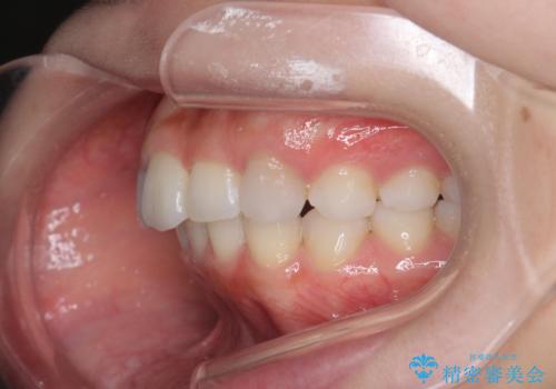 前歯のがたつき気になる。インビザラインモデレートの治療後
