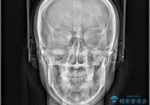 口ボコと歯のデコボコが気になる!|前歯が出ていて口が閉じにくい|審美ワイヤー矯正による口元の改善!の治療前