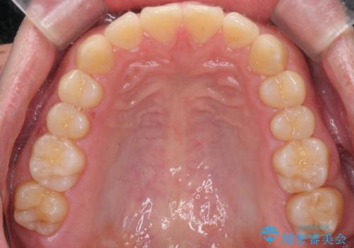 下の歯のがたつきが気になる。 インビザラン&ワイヤー部分矯正併用の治療後