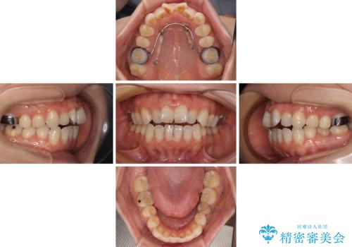 【モニター】飛び出した上顎前歯 補助装置を併用したインビザライン矯正治療の治療中