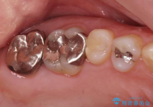 右奥歯治療が必要と言われた。