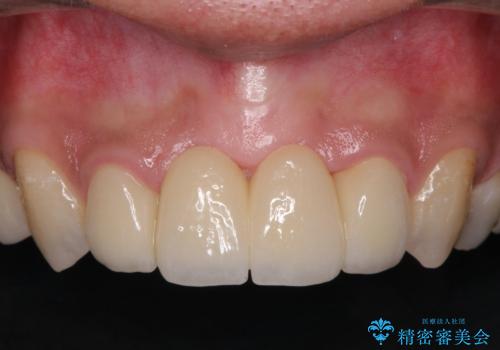 前歯ブリッジの症例 治療後