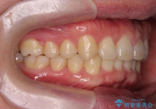 下の歯のがたつきが気になる。 インビザラン&ワイヤー部分矯正併用の治療後