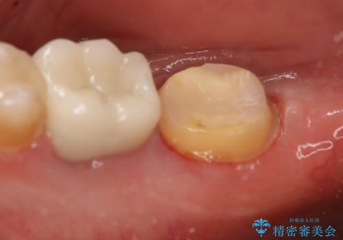 奥歯が痛む オールセラミッククラウンの治療中