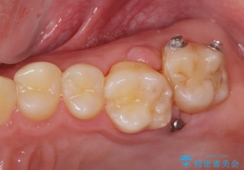 下の歯のがたつきが気になる。 インビザラン&ワイヤー部分矯正併用の治療後