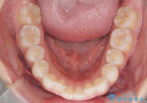 前歯のがたつき気になる。インビザラインモデレートの治療前