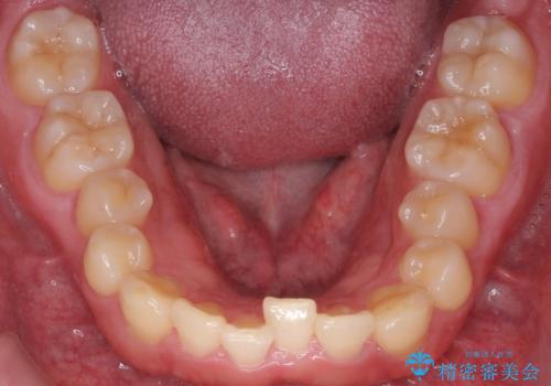 下の歯のがたつきが気になる。 インビザラン&ワイヤー部分矯正併用の治療前