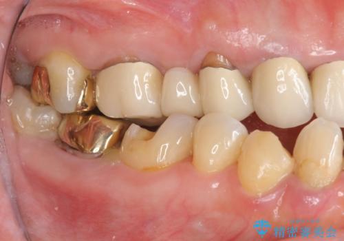 歯周ポケットの除去を併用したセラミック治療の症例 治療前