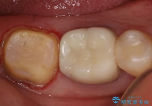 奥歯が痛む オールセラミッククラウンの治療中