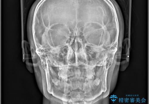 必ずしもワイヤーでなくても大丈夫!インビザラインでデコボコ歯列&過蓋咬合を改善の治療後