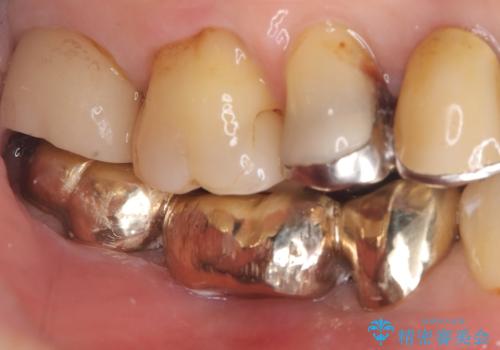 【ゴールドクラウン】セラミックのブリッジが何度も壊れるの治療後