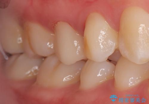 【根管治療】【セラミッククラウン】根っこが細くて治療できないと言われたの治療後