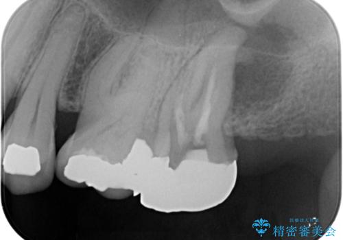 銀歯を白くしたいセラミック治療。の治療前